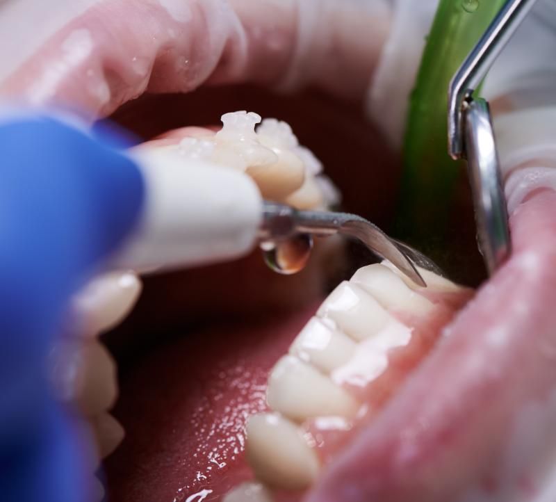 A person is getting their teeth examined by a dentist.