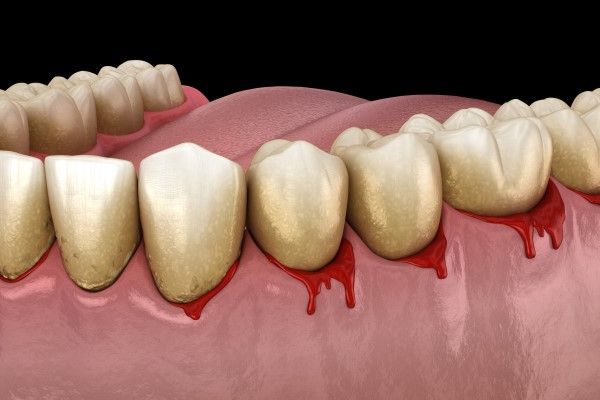 What Bleeding Gums May Indicate
