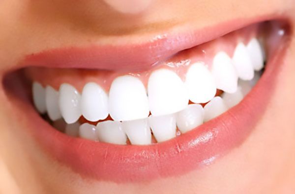 5 Things to Know About Dental Veneers
