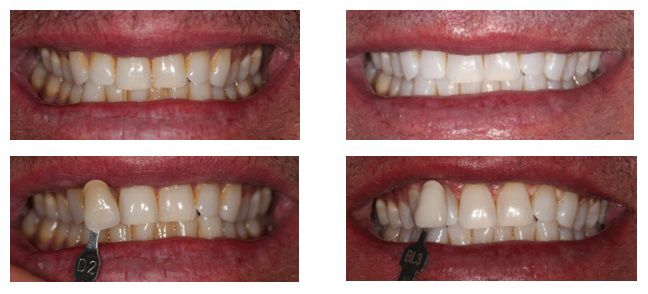 before and after dental in tucson az