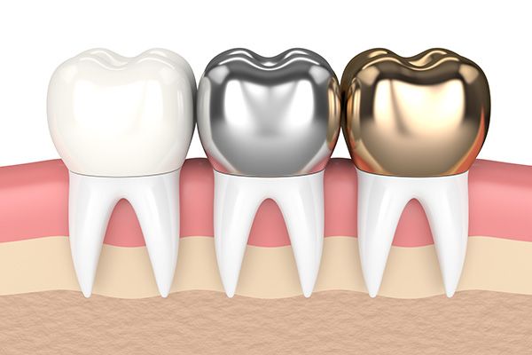 Metal Crowns vs. Porcelain Dental Crowns
