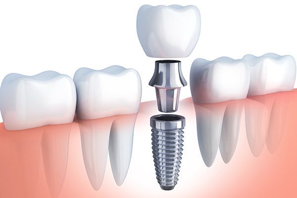 molar tooth implant
