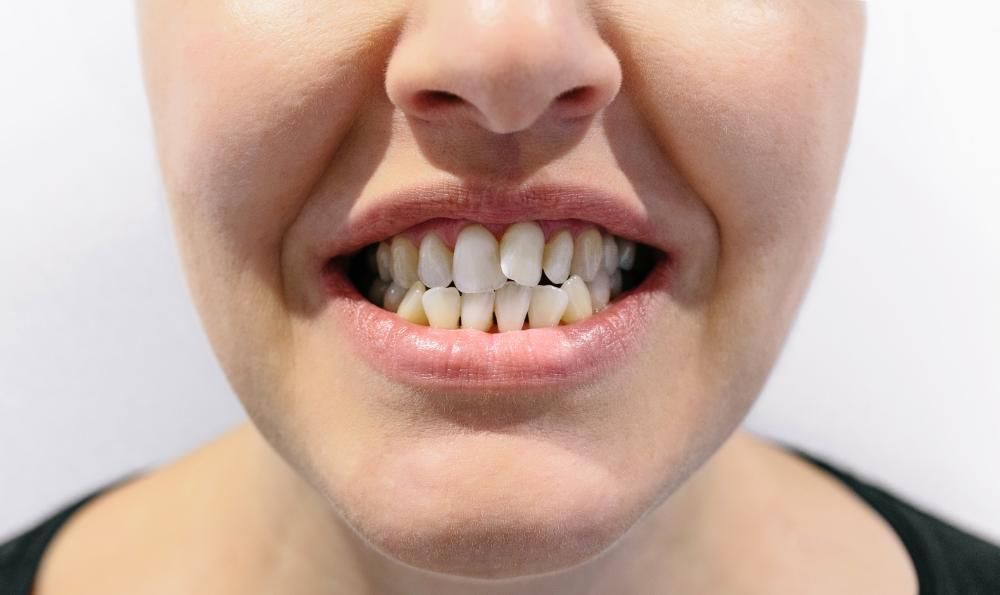 A close up of a woman's mouth with her misaligned teeth showing.