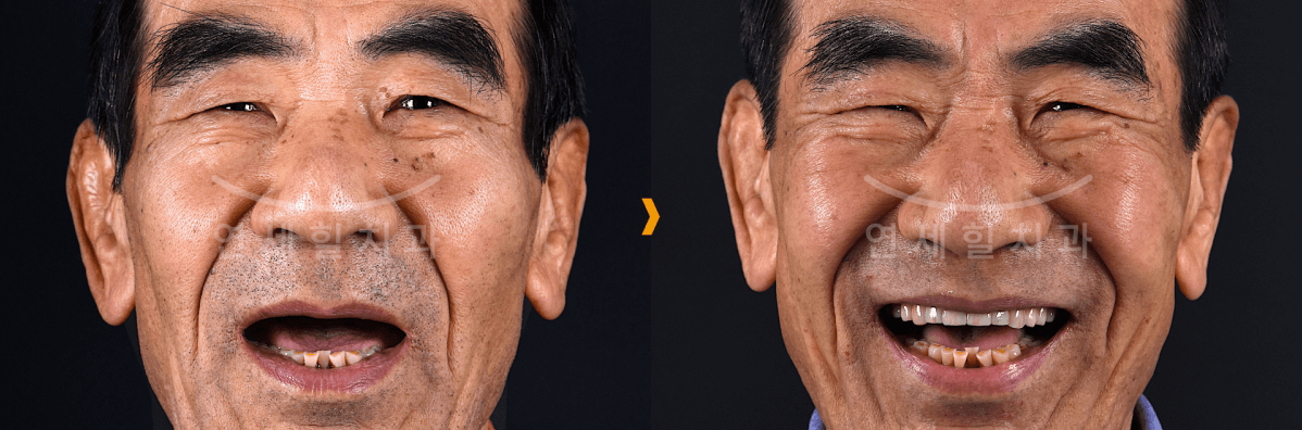 Side-by-side of a smiling Asian man showing missing and then restored teeth. Black background.