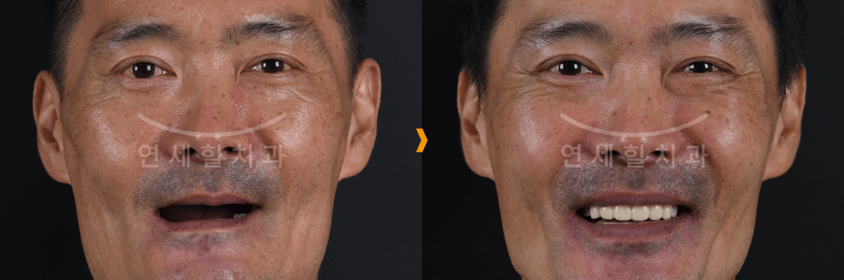 A man's face, before and after lip repair. The after shows a smile and teeth.