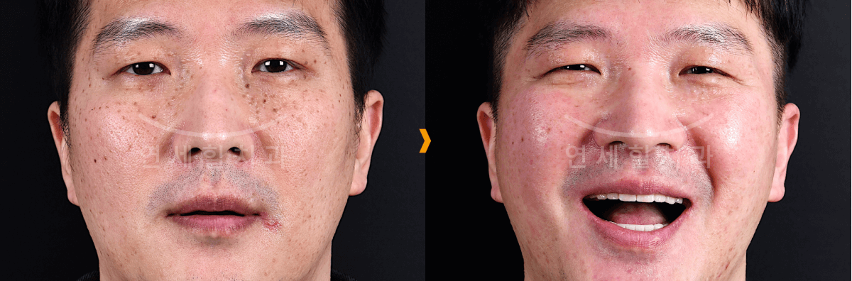 Before-and-after close-up portraits of a man with a neutral expression, then laughing.