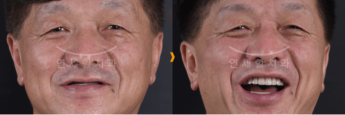 Before and after photos of a man, the after photo shows a brighter smile, with new teeth.
