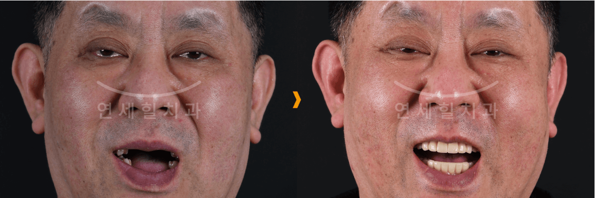 Before and after photos of a man's smile:  The man's teeth are fixed in the second photo.
