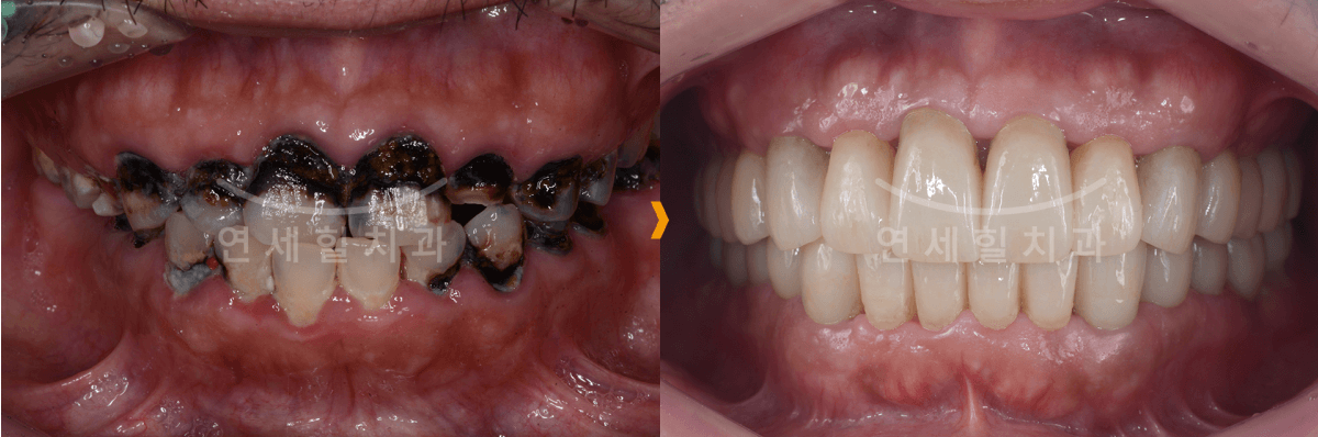 Before and after dental work: severely decayed teeth before, replaced with a full set of perfect white teeth.