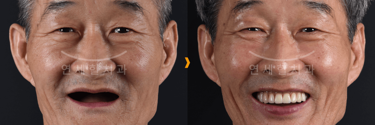 Before and after photo: Asian man with missing teeth smiling after receiving dental implants.