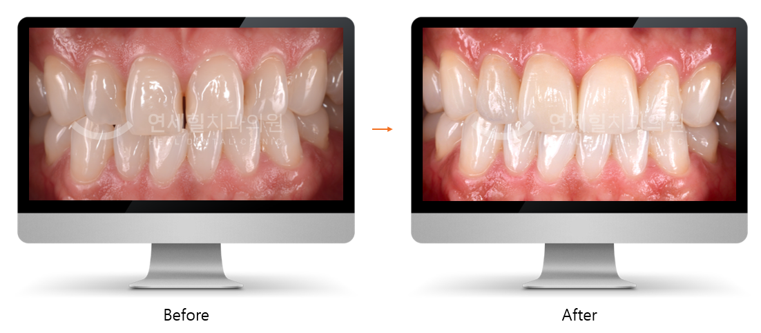 Before and after photo: Asian man with missing teeth smiling after receiving dental implants.