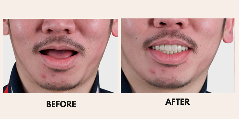 A man's face, before and after lip repair. The after shows a smile and teeth.