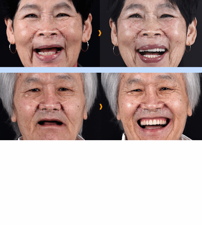 Two sets of before and after photos of older adults' smiles; one woman and one man.