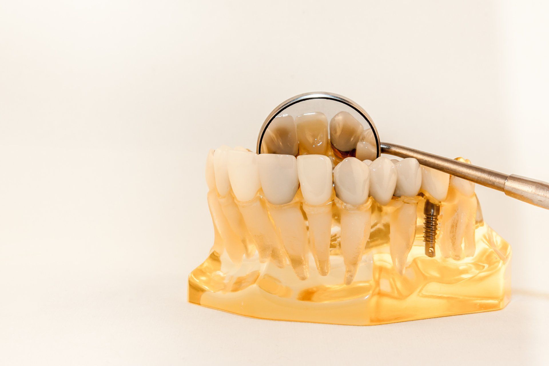 A model of a tooth with a dental implant and a dental mirror.