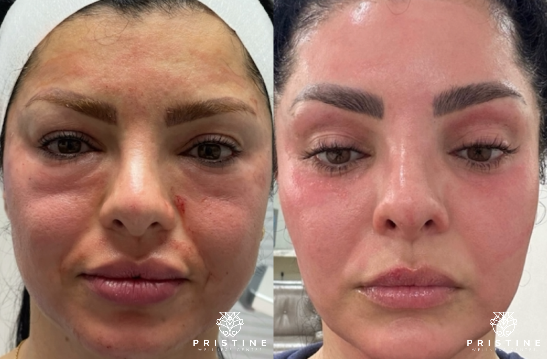 real patients before and after non-surgical facelift treatment in san ramon, ca at pristine wellness center - Dr. Homeira Izadi