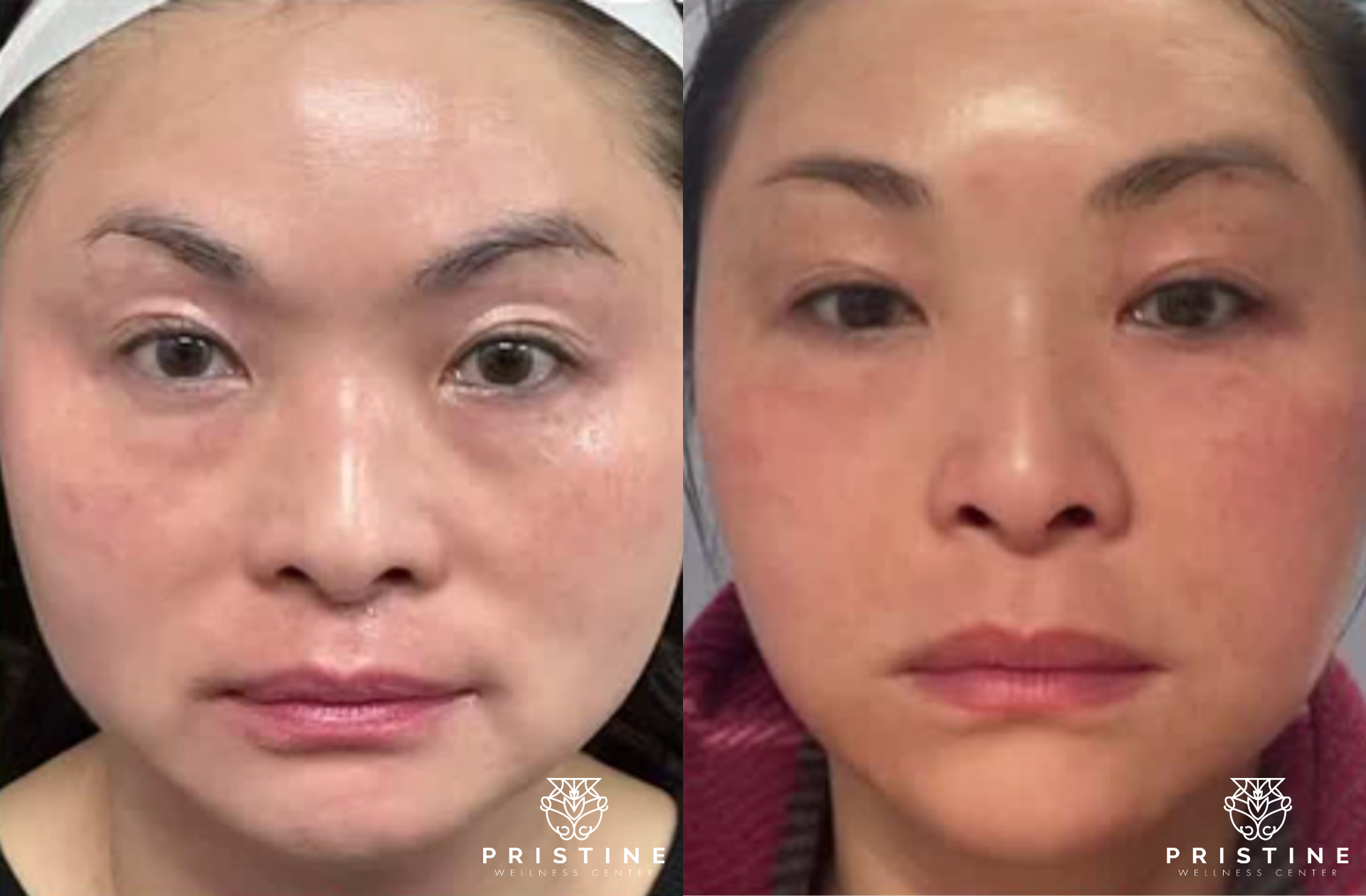 real patients before and after non-surgical facelift in san ramon, ca at pristine wellness center - Dr. Homeira Izadi