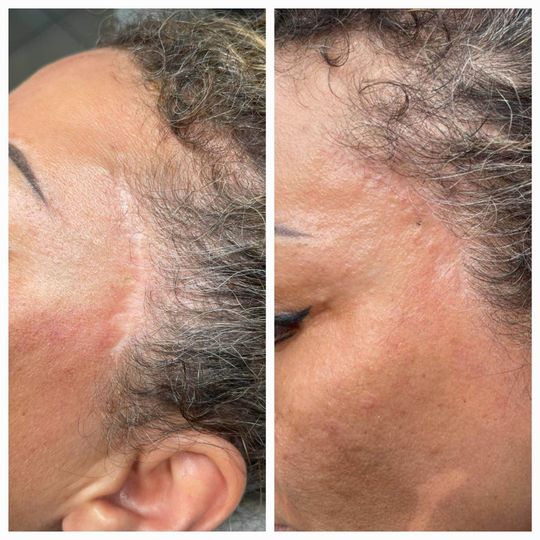 Primo piano di una testa dalla pelle scura con l'attaccatura dei capelli modellata con uno strumento di precisione.