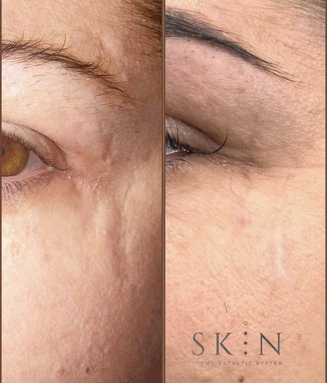 Primo piano di una testa dalla pelle scura con l'attaccatura dei capelli modellata con uno strumento di precisione.