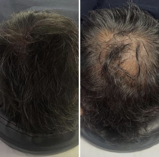 Primo piano di una testa dalla pelle scura con l'attaccatura dei capelli modellata con uno strumento di precisione.