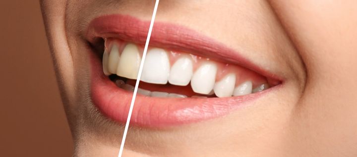 Denti sbiancati prima e dopo