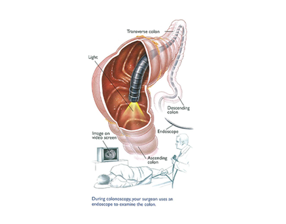 Colonscopy procedure