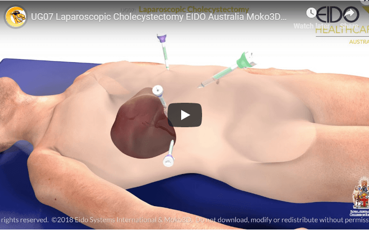 Gall bladder video screenshot