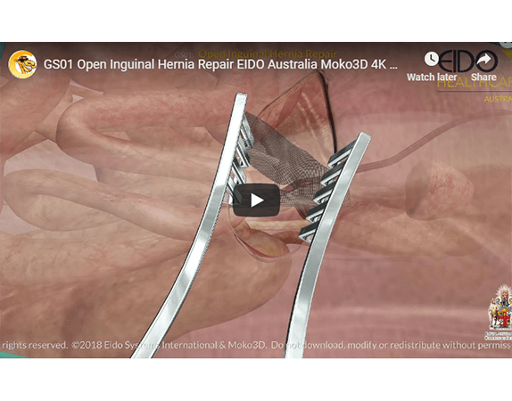 Hernia video screenshot