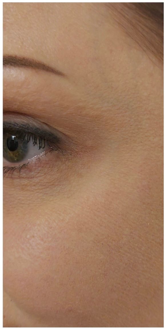 Kraaienpootjes botox kraaienpootjes vanaf €92, Aura Clinic Lommel