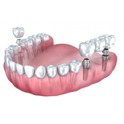 dental implants clinton township