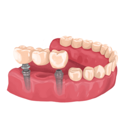 dental implant bridge