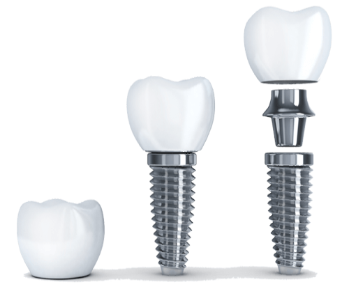 Dental Implant