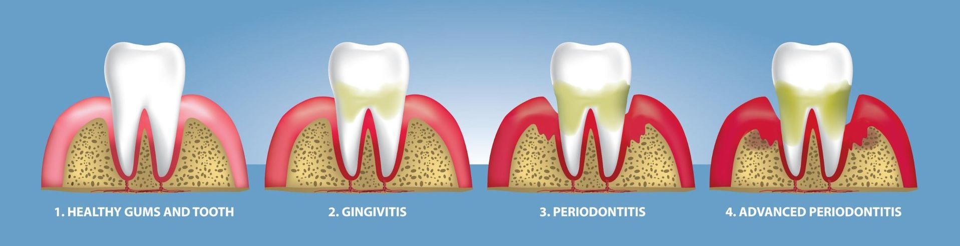 A diagram showing the stages of gum disease