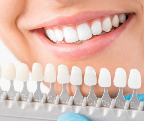 DENTAL VENEERS