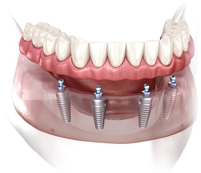 A computer generated image of a denture with dental implants.