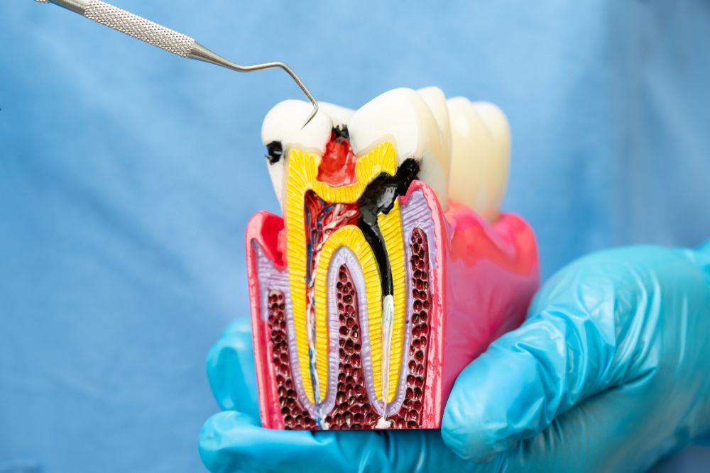 dentist holding dental implant, artificial tooth roots into jaw, root canal