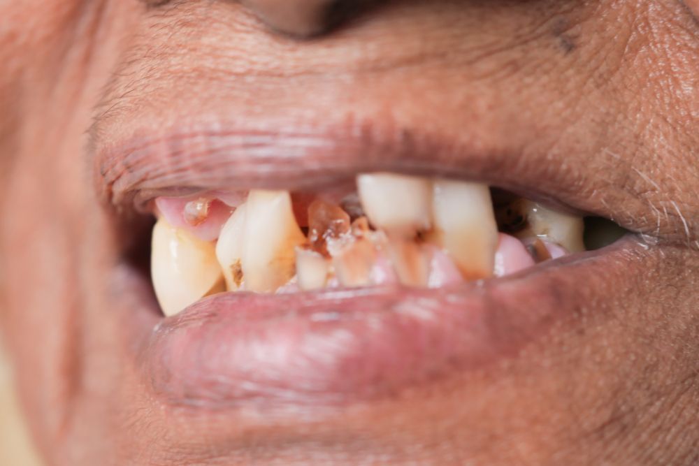 A close up of a person 's mouth with a lot of teeth missing.