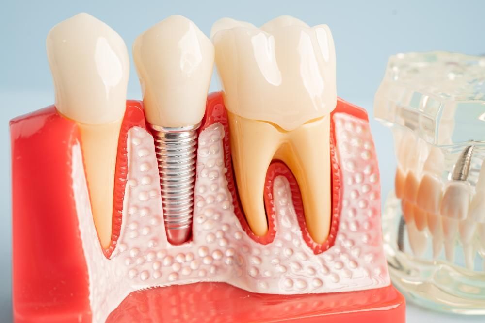 A model of a tooth with a dental implant in it.