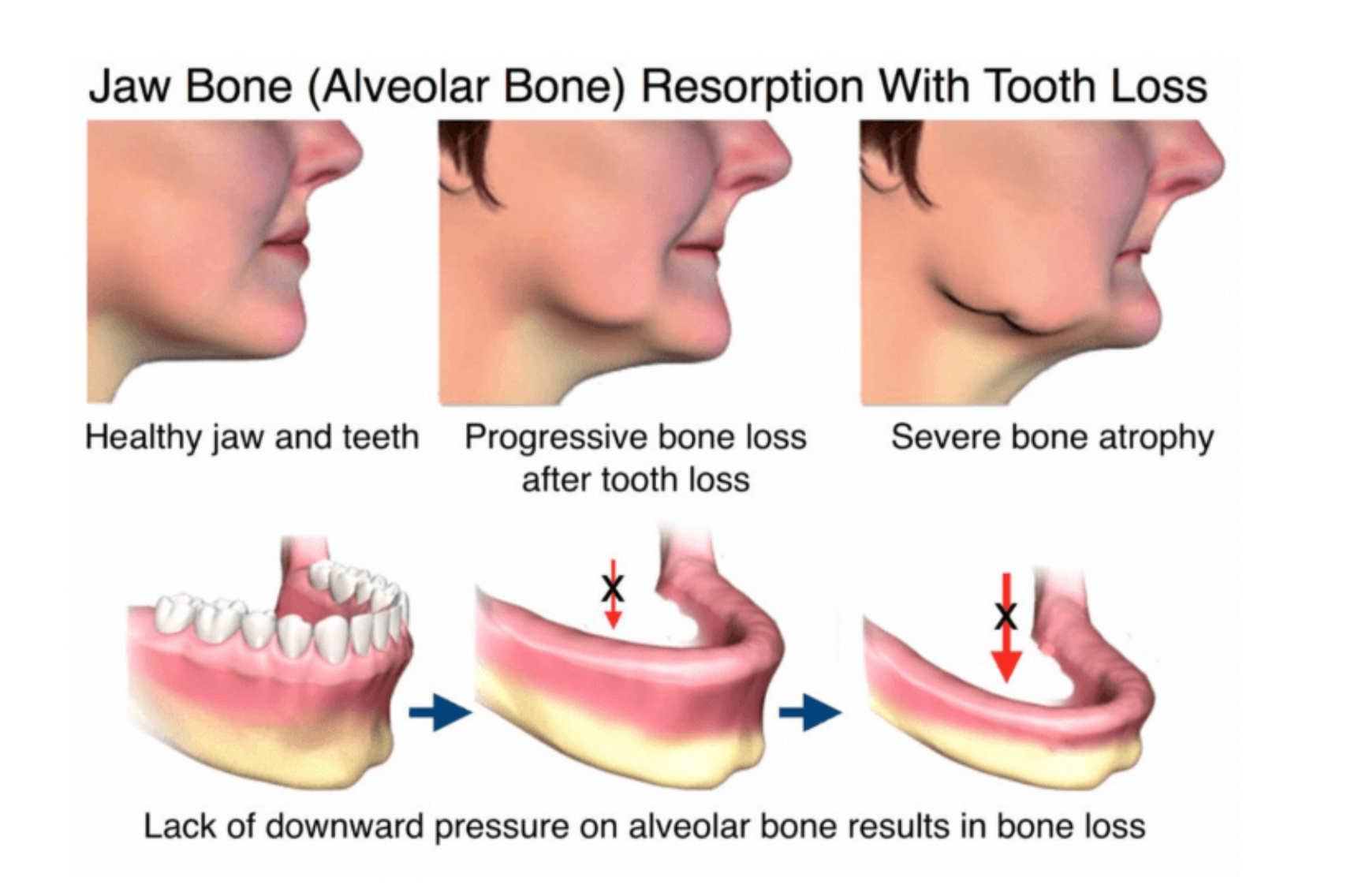 A diagram of a jaw bone resorption with tooth loss