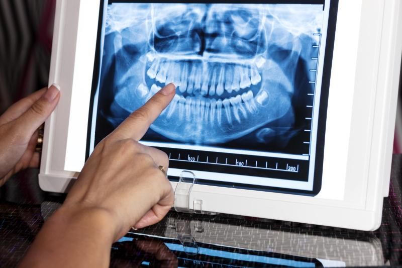 A person is pointing at an x-ray of a person 's teeth on a computer screen.