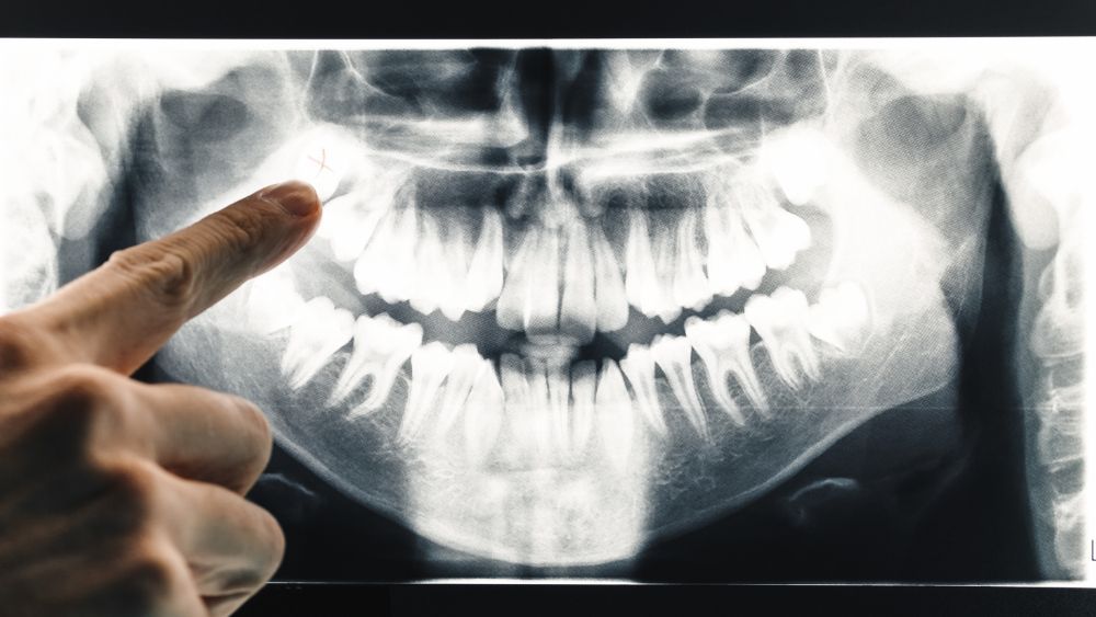 A person is pointing at an x-ray of a person 's teeth.