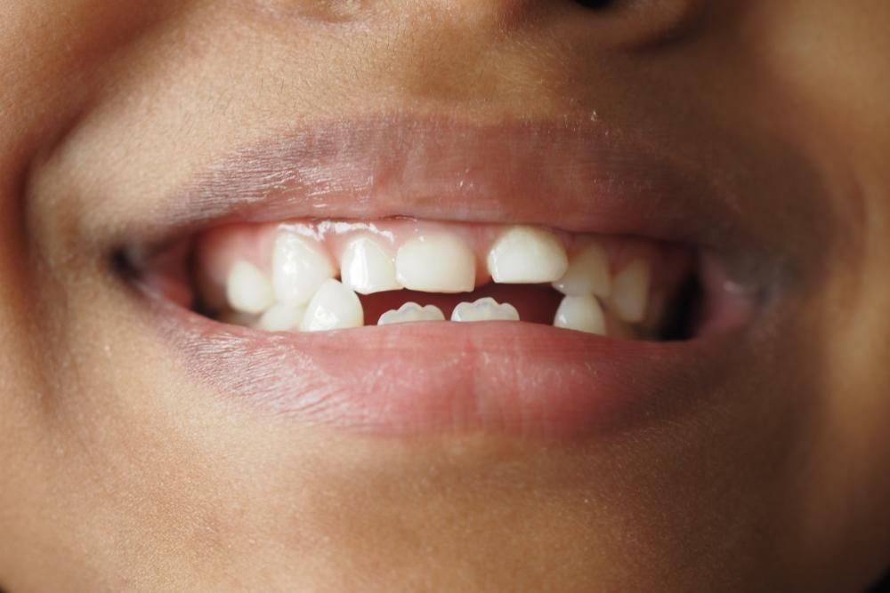 A close up of a person 's mouth with missing teeth.