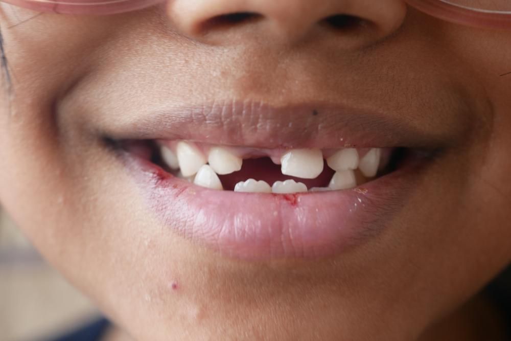 A close up of a person 's mouth with glasses and missing teeth.