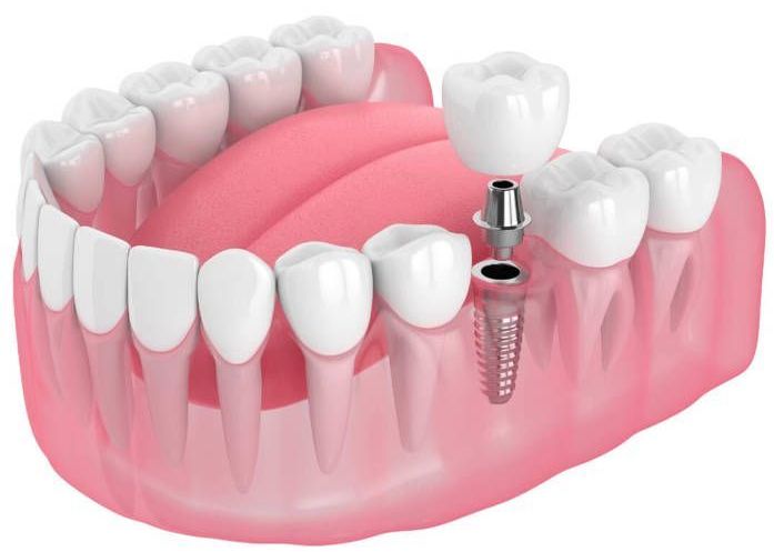 single tooth implant