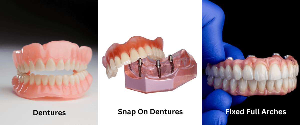 A collage of three pictures of dentures snap on dentures and fixed full arches