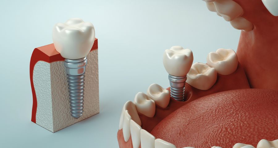 ricostruzione 3d impianto dentale