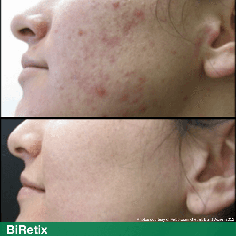 biretix duo cleanser