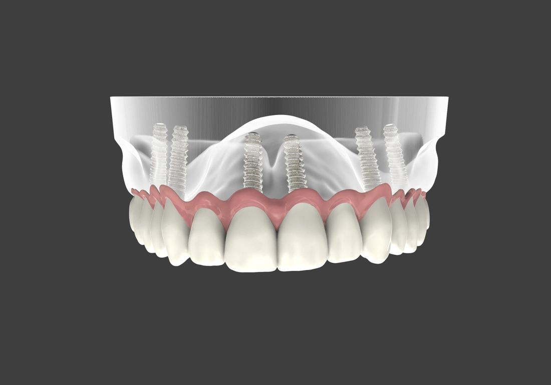 corone in zirconio