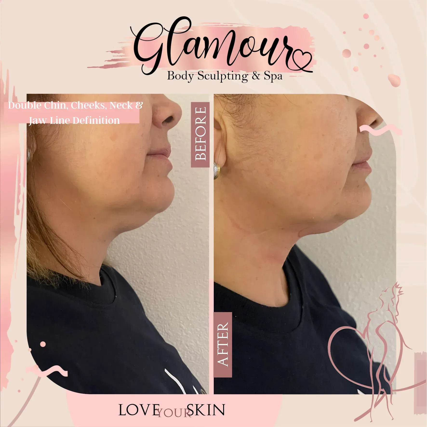 Comparison of woman's neck and jawline: Before shows more skin folds, After shows reduced folds. Body sculpting results.