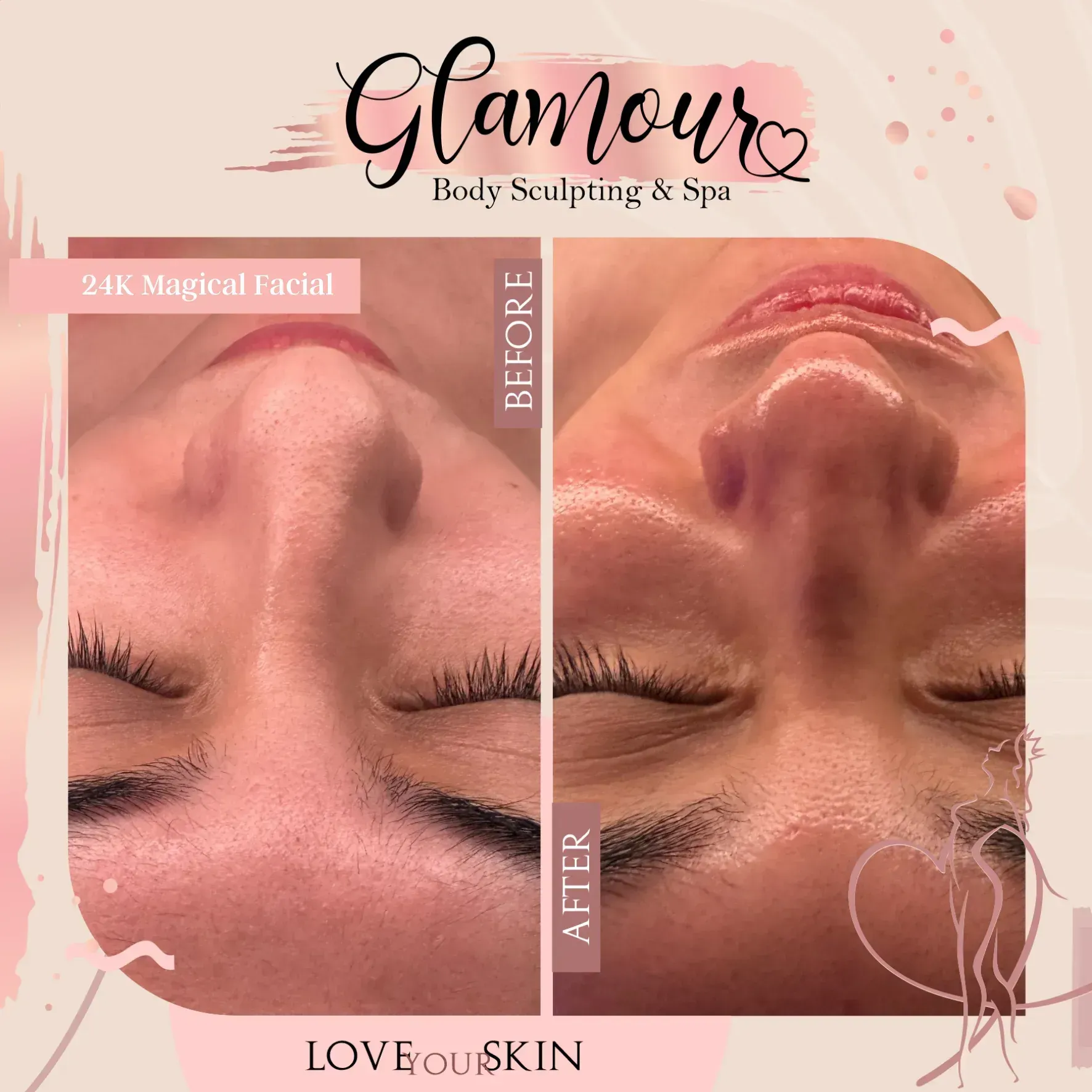 Before and after facial treatment photos showing improved skin.