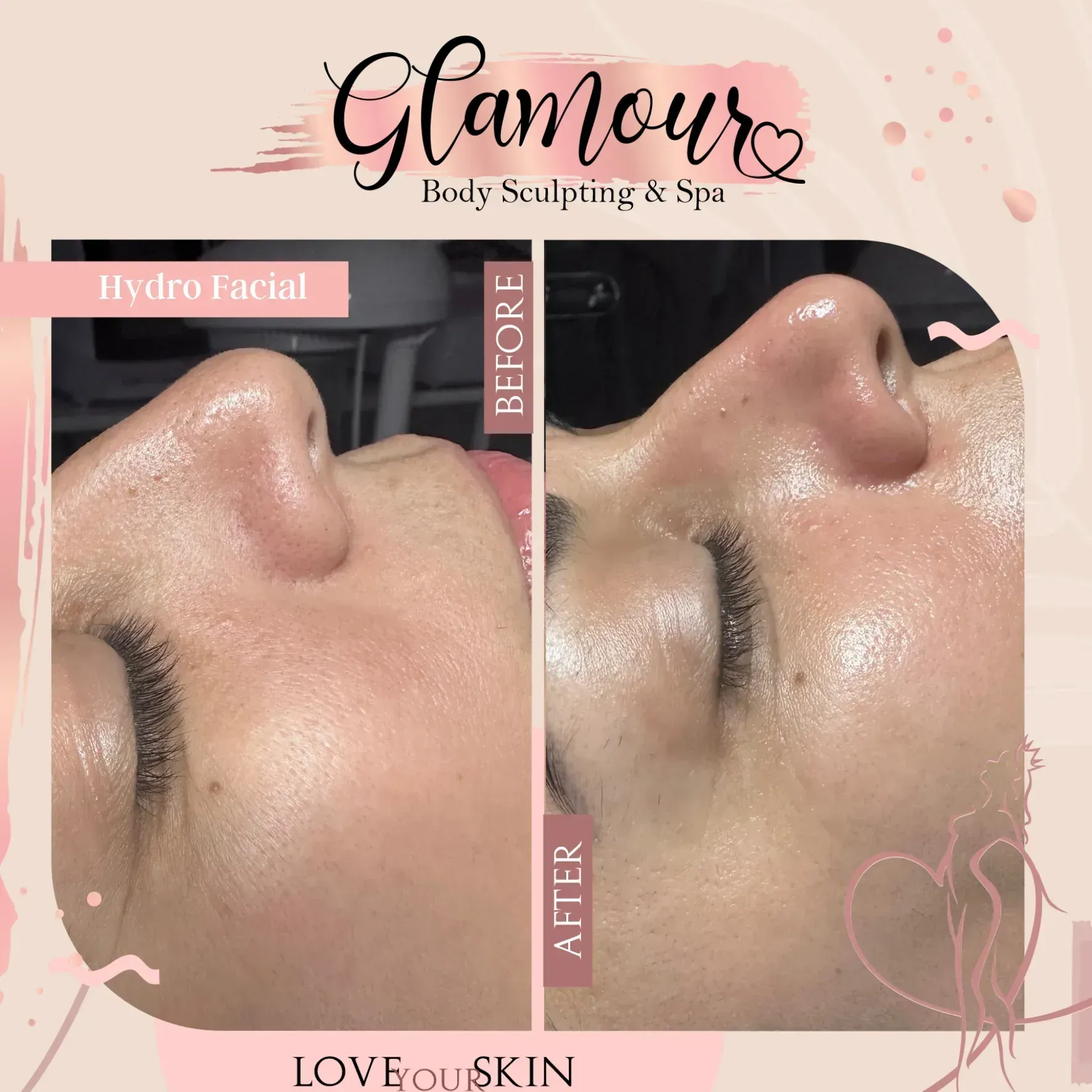 Hydro Facial before and after treatment on a nose, featuring improved skin texture and glow.